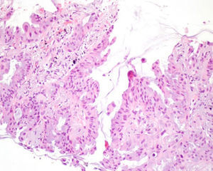 Haematoxylin and eosin staining demonstrating the acinar pattern of glandular differentiation observed in adenocarcinoma.