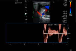 Doppler ultrasound of the right superficial femoral artery pseudoaneurysm. A typical “to-and-fro” waveform in the neck of the pseudoaneurysm is shown.