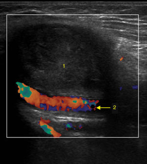 Doppler ultrasound six months after pseudoaneurysm correction. There is no blood flow in the aneurysm sac (1). The superficial femoral artery is patent (2) and distal right limb pulse is present.