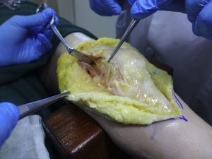 Medial patellofemoral ligament – knee anatomic dissection performed at the Anatomy Department of Oporto Medical School (images courtesy of Dr. Paulo Oliveira).