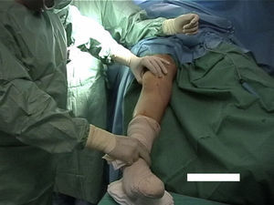 Objective confirmation of preoperative patellofemoral instability (images courtesy of Dr. Paulo Oliveira).