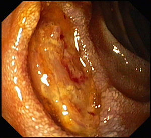 Ulcer in the second part of duodenum.