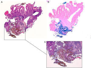 Duodenal mucosa with iron deposition. (A–C) Duodenal ulcer showing extracellular brown crystalline and fibrillar iron deposition over granulation tissue (H&E stain, 40× in A and 100× in C), highlighted by Perls’ stain, 40× (B).