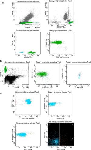 Plots of T-cell expression in peripheral blood from the studied patient after the last session. (A) Lymphocytes (cyan events), CD3+ effector T-cells showing CD4+ and CD8+ populations (green and navy, respectively). (B) Regulatory T-cells CD4+CD25+high showing phenotype CD25+CD127−low (navy). (C) Atypical cell clusters majority CD3+CD4+ (green) displaying CD7− (cyan) and CD26− (orange).