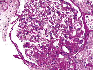 Obesity-related perihilar focal segmental glomerulosclerosis on a background of glomerulomegaly. Periodic Acid-Schiff stain, original magnification 400×.