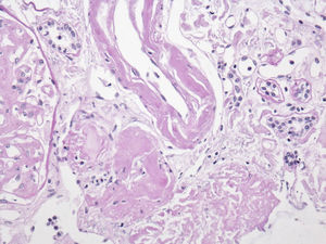 El material amiloide también se encuentra depositado en el intersticio, en las paredes tubulares y arteriolares.