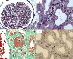 Lesiones histológicas de rechazo mediado por anticuerpos agudo/activo. a) Glomerulitis: células mononucleadas y polimorfonucleares en capilares glomerulares y edema capilar (flecha); b) capilaritis peritubular (flecha): células mononucleares y polimorfonucleares en capilares peritubulares por técnica de PAS; c) microngiopatía trombótica: trombosis arteriolar (flecha) (técnica tricrómicro de Masson); d) C4d positivo en capilares peritubulares (flecha). Inmunohistoquímica (inmunoperoxidasa).