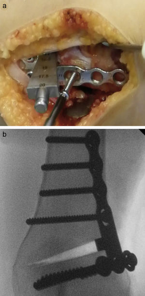 Imágenes intraoperatorias donde se observa: a) la fijación de la placa con 3 tornillos distales de esponjosa, y b) imagen de escopia con el aspecto de la placa fijada completamente.