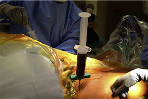 Fotografía quirúrgica de aspiración de médula proximal a la espina iliaca anterosuperior derecha. El paciente está posicionado en decúbito dorsal, con los miembros inferiores hacia la derecha de la fotografía y la cabeza hacia la izquierda.