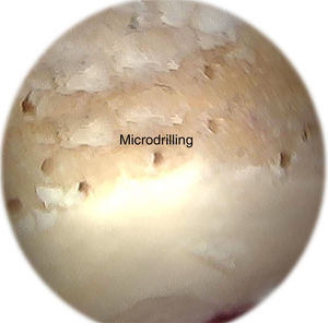 Imagen artroscópica de microperforaciones realizadas con una guía de 1mm en el acetábulo durante la artroscopia de cadera. Similar a la microfractura, las microperforaciones requieren la remoción de la capa calcificada de cartílago. Las microperforaciones se realizan con una guía flexible (Stryker, Phoenix, AZ, EE.UU.).