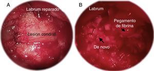 Imágenes artroscópicas de: A) preparación en seco de la lesión condral; B) implantación de De Novo NT. El pegamento de fibrina se aplica primero en la base de la lesión. Luego De Novo NT es colocado de manera artroscópica. Para finalizar, una segunda capa de pegamento de fibrina es aplicada sobre el lecho de De Novo NT.