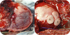 Imagen intraoperatoria de una luxación controlada de cadera izquierda en la que se observa: A) lesión condral en zona de carga de 4×3cm; B) luego de la colocación de 3 aloinjertos osteocondrales frescos (imagen cedida por el Prof. K. Draenert).