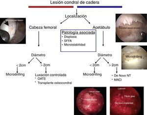 Algoritmo del tratamiento para lesiones condrales de cadera.