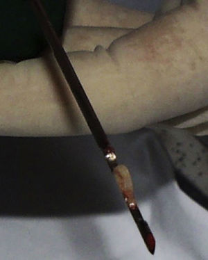 Muestra de tejido obtenida con aguja gruesa (tru-cut).