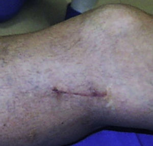 Ejemplo de herida quirúrgica longitudinal, tras biopsia incisional de lesión en la tibia proximal. Cierre con puntos intradérmicos.