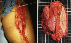 a) Resección del trayecto de la biopsia incisional de la paciente de la figura 8. b) Resección con márgenes amplios del tumor y con el trayecto de la biopsia incluido en la misma.