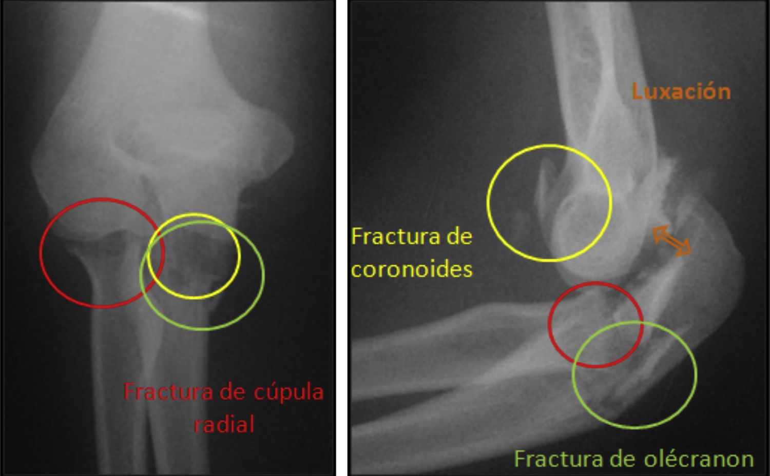 Fractura luxaci n Del Complejo Distal Del Codo es La T trada Terrible Fractura luxaci n Del Complejo Distal Del Codo es La T trada Terrible