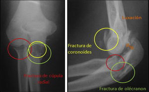 Radiografía frente y perfil de codo derecho donde está presente la fractura de olécranon, cúpula radial y coronoides asociado a luxación.
