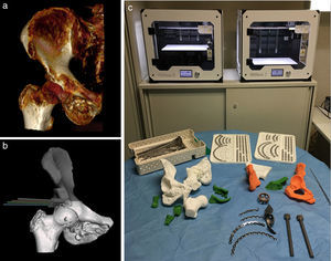 Planificación quirúrgica de osteosarcoma pélvico: resección y reconstrucción con aloinjerto. a) Reconstrucción 3D: estudio de imagen TC. b) Diseño de guías para osteotomías de resección. c) Piezas impresas en 3D. Premoldeado en material de síntesis.