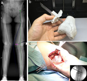 Osteotomía varizante de fémur izquierdo. Flujo de trabajo. a) Planificación. b) Simulación. c) Ejecución.