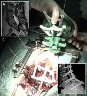 Guías de posicionamiento para introducción de tornillos pediculares en espondilolistesis. a) Imagen preoperatoria. b) Intervención quirúrgica. c) Imagen postoperatoria.