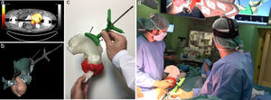 Navegación quirúrgica en angiosarcoma pélvico. a) Estudio PET-TC preoperatorio. b) Planificación y diseño de instrumental de posicionamiento. c) Simulación sobre piezas impresas. d) Intervención quirúrgica.
