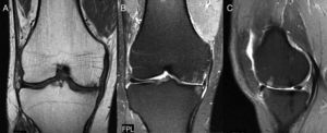 A-C: RM de una rodilla con signos óseos y de partes blandas de artrosis. La RM puede ser un buen instrumento de valoración en el tiempo.