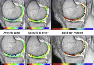 Delayed Gadolinium Enhanced MRI Cartilage (dGEMRIC) para la medición de la concentración de glucosaminoglucanos y sus cambios. Ejemplo en un corredor de maratón antes y después de correr. Imagen cedida por el Dr. A. Restrepo, Canadá, por cortesía de VirtualScopics.