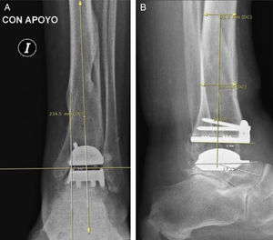 Paciente del grupo 1: artroplastia total de tobillo (ATT). A) Radiografía de tobillo izquierdo, con carga, de frente. B) De perfil. La medición angular entre el eje longitudinal de la tibia y el componente protésico fue realizada según la técnica de Hintermann.