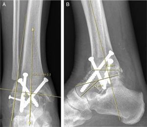 Paciente del grupo 2: artrodesis de tobillo (AT). A) Radiografía de tobillo derecho, con carga, de frente. B) De perfil.