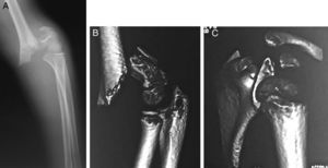 Fractura supracondílea pediátrica del húmero, donde se aprecia la rotación del fragmento proximal y la lateralidad del fragmento distal (A y B), con la rotación interna del hombro (C).