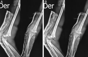 Fractura supracondílea pediátrica del húmero: el fragmento proximal contacta con la arista lateral del fragmento distal y la empuja haciendo que rote (las flechas indican el punto de contacto).
