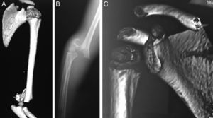 A) TC-3D completa, de hombro y codo, en fractura supracondílea de húmero pediátrica; se visualiza que el hombro no está rotado ni tampoco el fragmento proximal. B) Rotación interna del fragmento proximal, como lo evidencia la posición de la corredera bicipital hacia dentro y como se observa en la tomografía tridimensional en C.