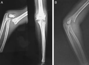 Secuencia de imágenes en que se aprecia (A y B) la lateralidad del fragmento distal en radiografía sagital estricta.