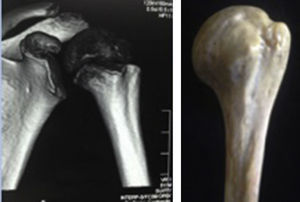 Posición anatómica normal del hombro en vista anterior, en la TC y en el modelo cadavérico.