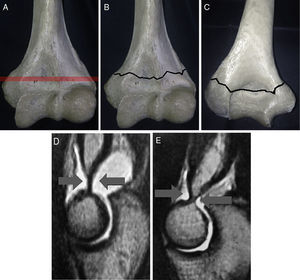 A) Línea imaginaria interepicondílea (epitrócleo-epicondílea). B y C) Las fracturas supracondíleas en los niños se producen, con mayor frecuencia, en la porción más débil de la paleta humeral, en la línea interepicondílea, pues es, como se observa en la RM (D y E), la porción más delgada en el plano sagital.