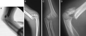 Radiografías sagitales de codo en fracturas supracondíleas pediátricas. A y B) Ambos fragmentos tienen el mismo diámetro. C) Radiografía lateral estricta: se observa el fragmento distal completamente lateral, pero no ocurre así con el fragmento proximal, el cual se observa completamente rotado. D) Se aprecia moderada rotación del fragmento proximal.