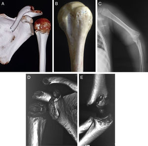 A) TC-3D que presenta la corredera bicipital hacia el borde interno, significando que ha rotado internamente. B) Húmero proximal cadavérico en la misma posición que la TC de la figura A. C) Proyección lateral no estricta, pues el rayo atravesó el codo en semiflexión y pronación. Parece que el fragmento distal está rotado y el hombro está antero-posterior, pero al hacer la TC-3D se observa (D) la corredera bicipital hacia el borde medial, lo que quiere decir que el hombro rotó internamente. E) La TC-3D en el codo presenta el fragmento proximal que está engranado en el fragmento distal. La arista lateral apunta hacia delante y la medial hacia atrás.