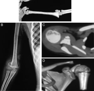 Fractura supracondílea de húmero pediátrica. A y B) Se muestra la no rotación del fragmento proximal ni la del distal. C y D) En la TC la corredera bicipital mira hacia el borde lateral.