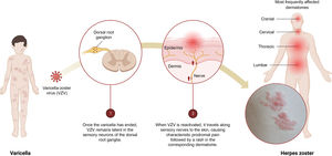 Infographic on the primary infection–latency–reactivation of the varicella-zoster virus (VZV). 1) Once the varicella episode has ended, VZV remains latent in the sensory neurons of the dorsal root ganglia. 2) When VZV is reactivated, it travels along the sensory nerves to the skin causing characteristic prodromal pain followed by a rash in the corresponding dermatome.