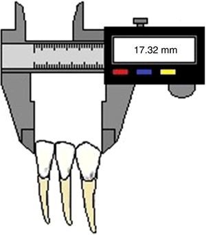Dental tissues measured for the Carrea method: lower central incisor, lower lateral incisor, and lower canine.