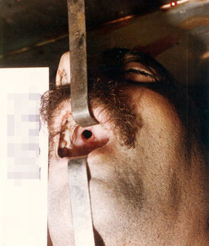 Perforation of the palate (case 1, suicide).