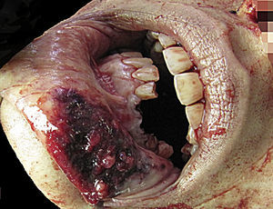 Dental avulsion and lip injuries (case 3, homicide).