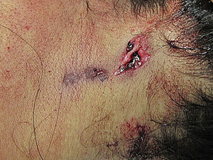 Cervical exit wound (case 3, homicide).