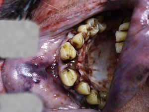 Anterior dental extrusion, lip contusions (case 4, suicide).