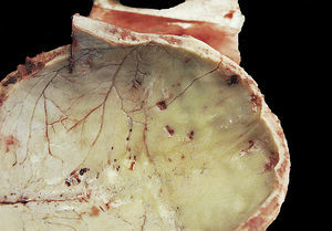 Impact of buckshot on endocranium (case 5, suicide).