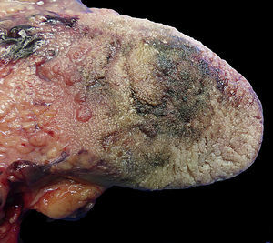 Burns on the tongue (case 6, suicide).