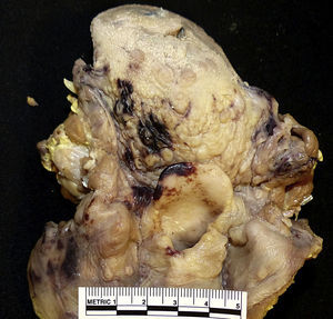 Burns on the tongue and larynx (case 6, suicide).