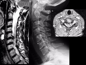 Acute disc herniation after traffic accident with initially minor trauma. The patient progressively developed left cervicobrachialgia and was diagnosed with a herniated disc 3 weeks after the accident (arrows in a and c). The central image (b) corresponds to the postoperative control X-ray. An intersomatic cage in C5–C6 is visible due to the radiopaque markers (arrowheads in b).