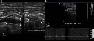 Doppler ultrasound of the supra-aortic trunks with thoracic outlet manoeuvres. Note the morphologically arterial compression (arrows in a, which show reduced breathing) and in the Doppler ultrasound of the subclavian arteries, with Adson's manoeuvre (loss of the pulse in b with abduction, extension and external rotation of the shoulder). This lesion, associated with or aggravated by CS, often goes unnoticed, unless tests such as Doppler ultrasound are performed with this type of manoeuvre.